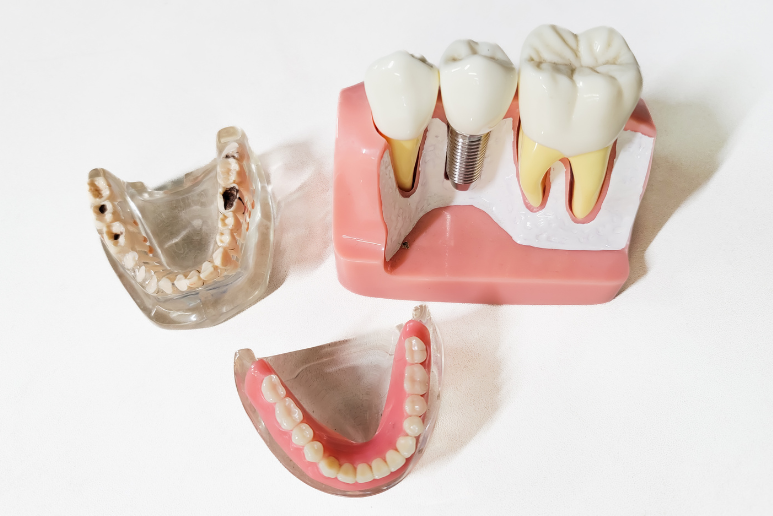 Mua Implant Chính Hãng Tại Bình Chánh