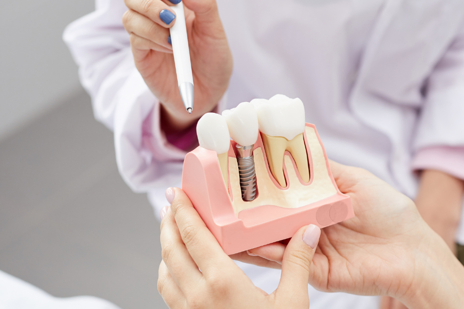 unident cung cap implant gia hop ly tai quan 3 va khu vuc tp hcm