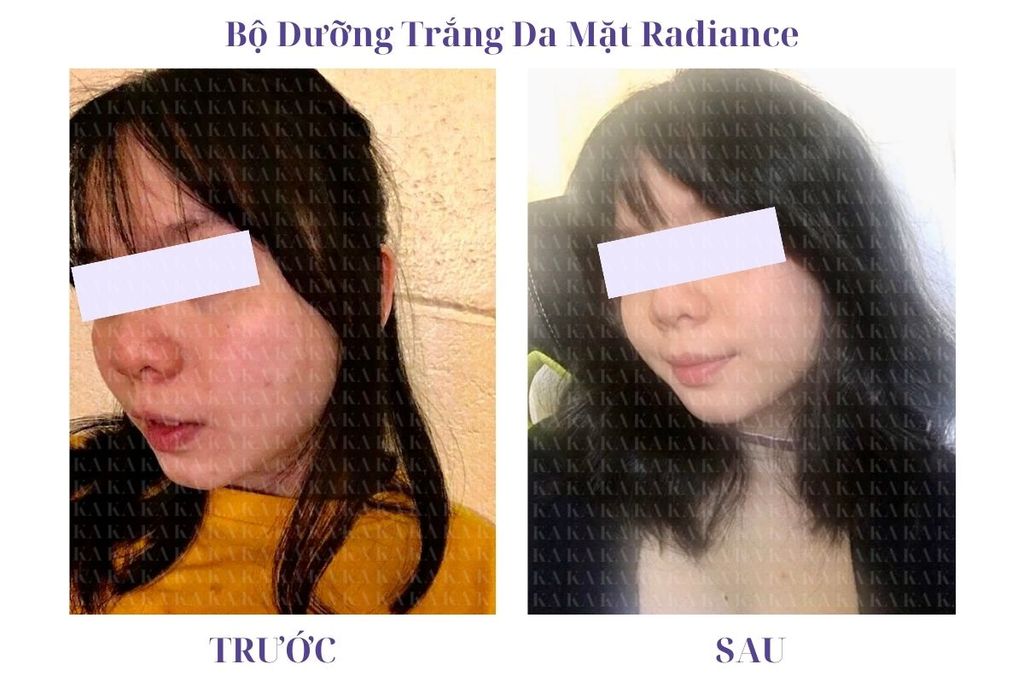 Phản hồi Bộ Dưỡng Trắng Da Mặt Radiance KA GCG