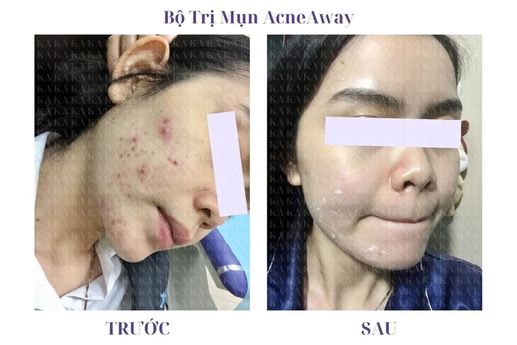 Phản hồi Bộ Trị Mụn AcneAway KA GCG