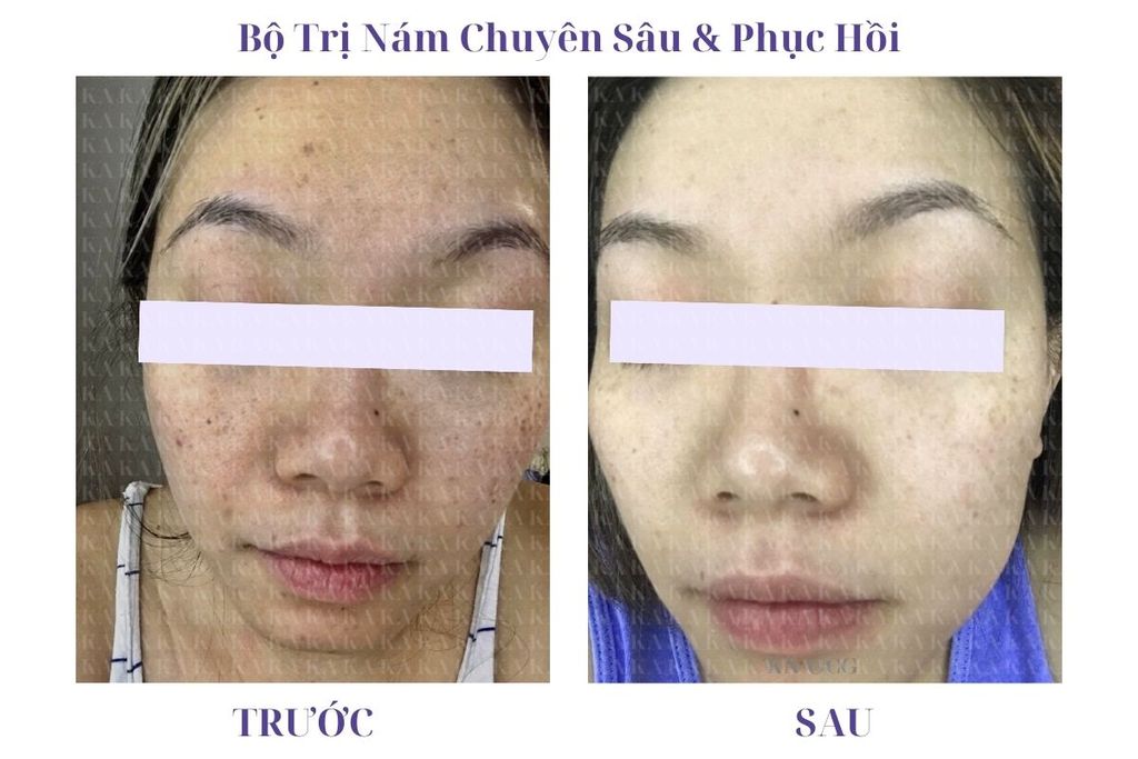 Phản hồi  Bộ Trị Nám Da Chuyên Sâu & Phục Hồi KA GCG