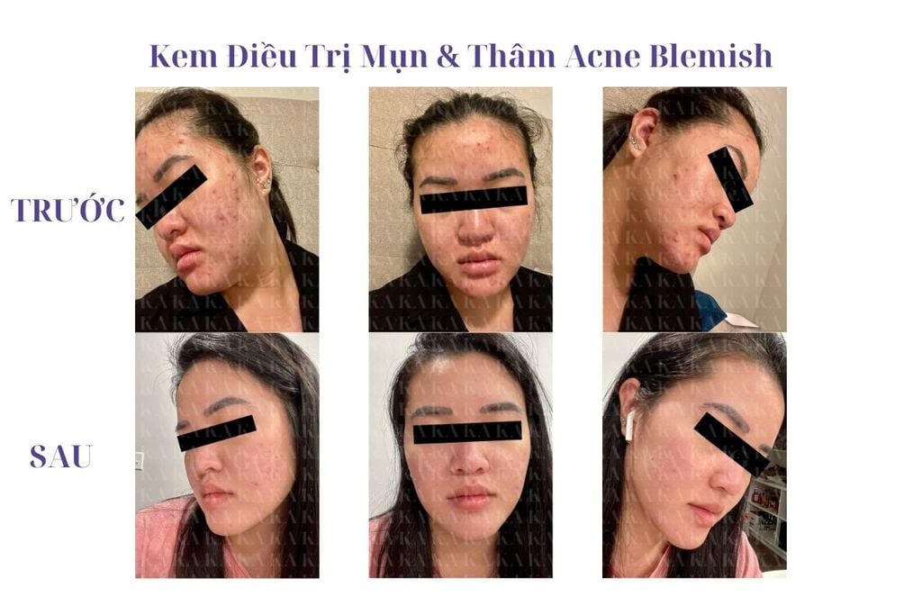 Phản hồi Kem Điều Trị Mụn & Thâm Acne Blemish