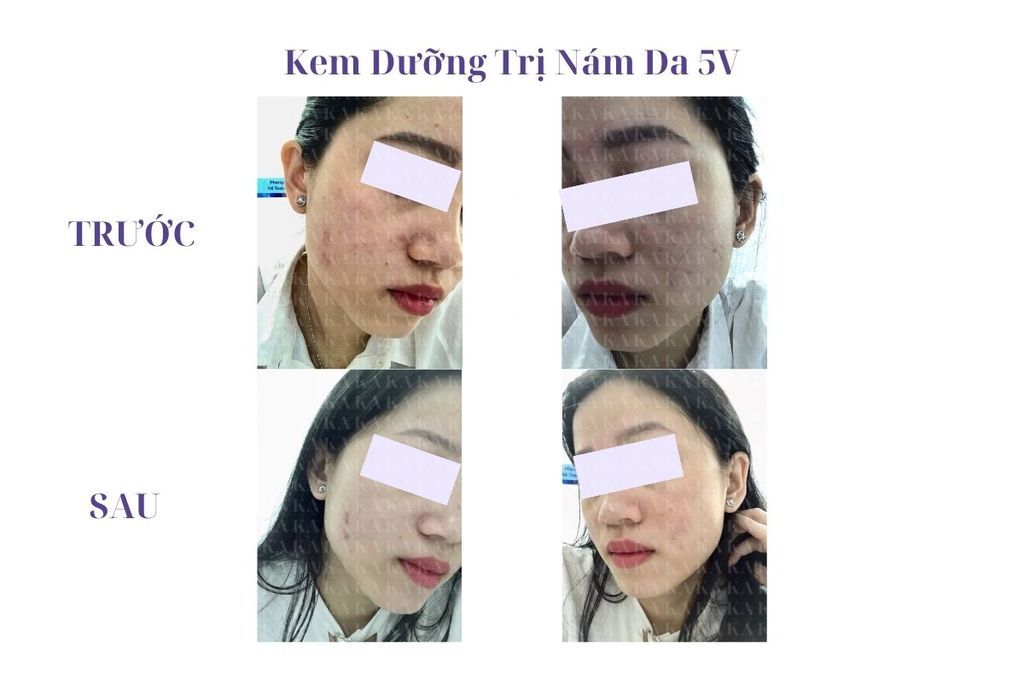 Phản hồi Kem Dưỡng Trị Nám Da 5V KA GCG