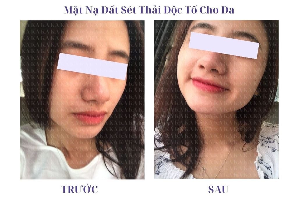 Phản hồi Mặt Nạ Đất Sét Thải Độc Tố Cho Da