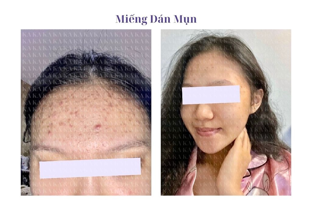 Phản hồi Miếng Dán Mụn