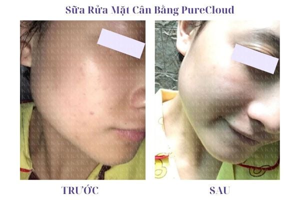 Phản hồi Sữa Rửa Mặt Cân Bằng PureCloud