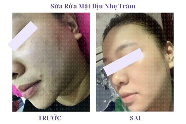 Phản hồi Sữa Rửa Mặt Dịu Nhẹ Tràm KA GCG