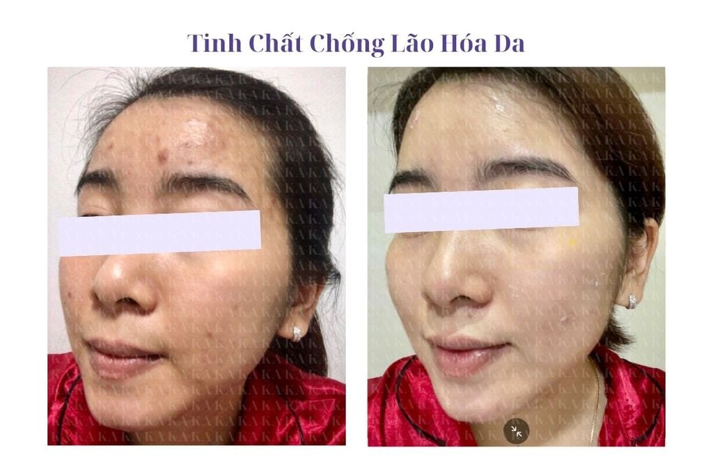 Phản hồi Tinh Chất Chống Lão Hóa Da KA GCG