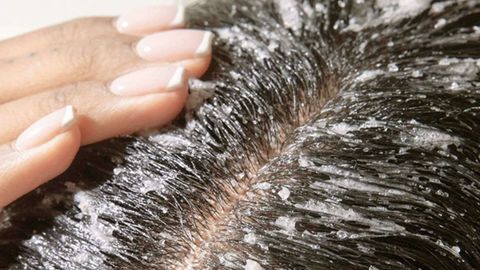 VÌ SAO CẦN TẨY TẾ BÀO CHẾT DA ĐẦU?
