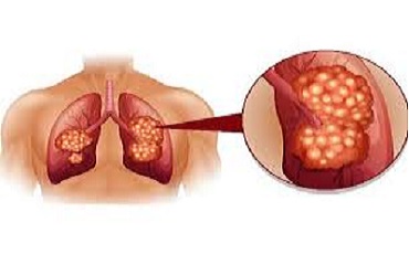 Cách phòng tránh và điều trị bệnh lao phổi