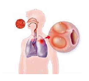 Nguyên nhân và cách diều trị lao phổi