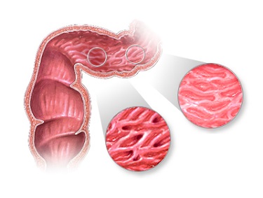 Nguyên nhân triệu chứng và cách chữa bệnh viêm đường ruột
