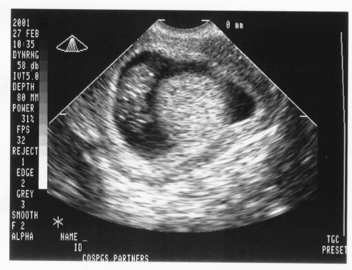 Sự phát triển thai nhi 2 tuần tuổi