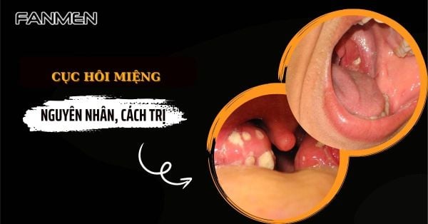 Cục Hôi Miệng: Nguyên Nhân, Triệu Chứng Và Cách Điều Trị