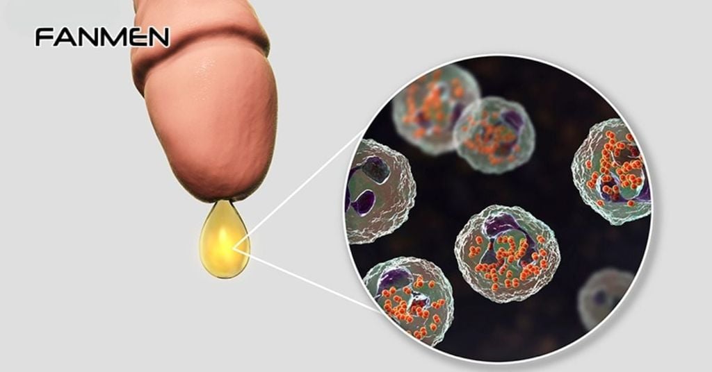 Ngứa rát vùng kín nam giới do lậu