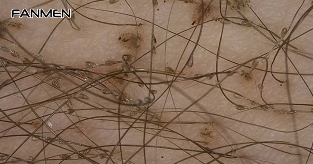 Nguyên Nhân Bị Ngứa Ở Chân Lông Vùng Kín Nam Giới