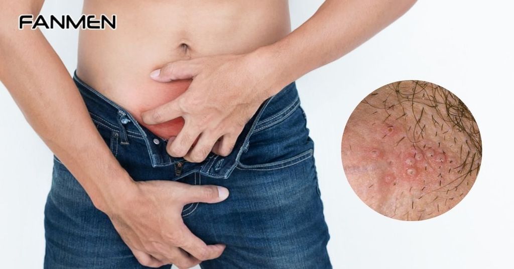 Biểu hiện của mụn rộp vùng kín nam