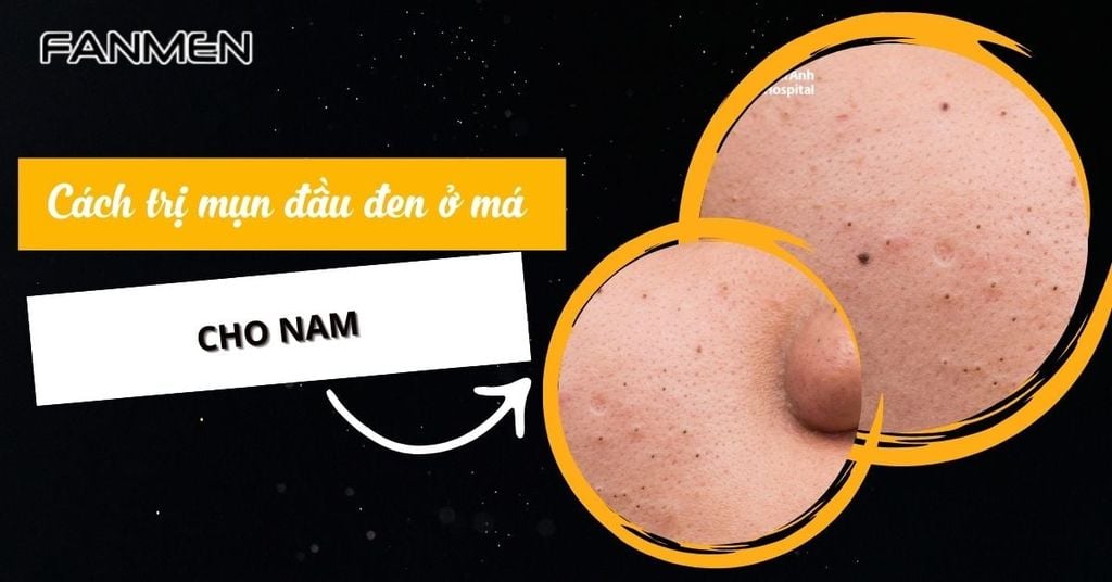 Cách trị mụn đầu đen ở má cho nam