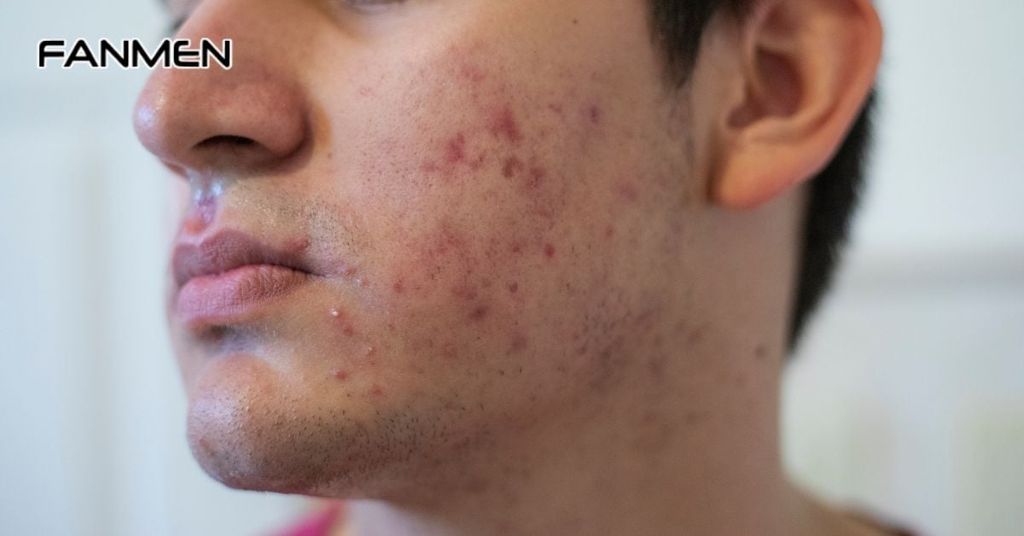 Đặc điểm của mụn ở quai hàm