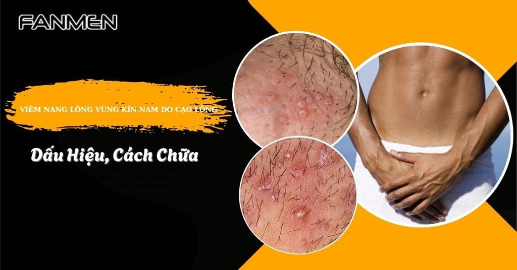 viêm nang lông vùng kín nam do cạo lông