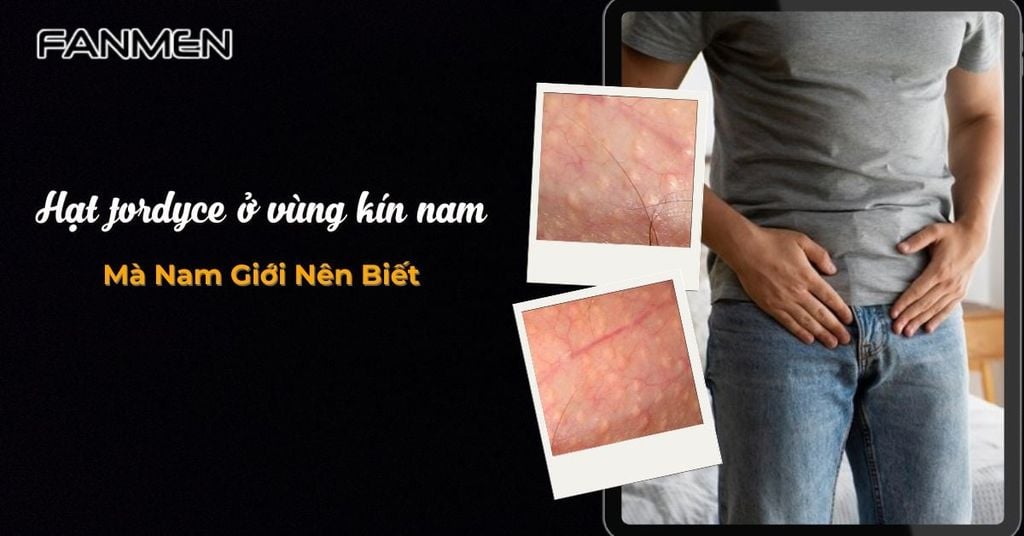 Hạt fordyce ở vùng kín nam