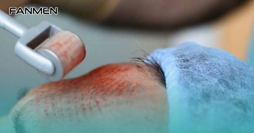 Trị sẹo rỗ bằng phương pháp lăn kim PRP