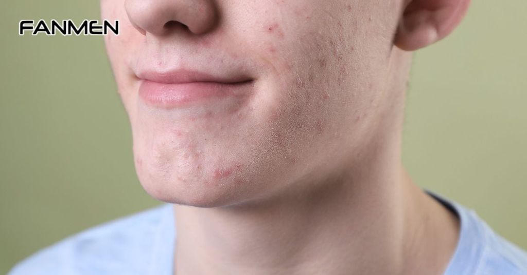 Nhiều mụn ở vùng cằm và xương hàm