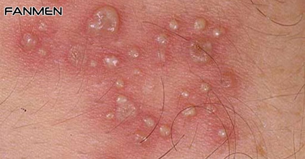Nổi mụn nước ở vùng kín nam do rộp sinh dục