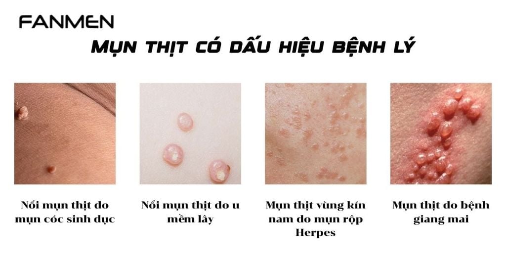 Mụn thịt có dấu hiệu bệnh lý