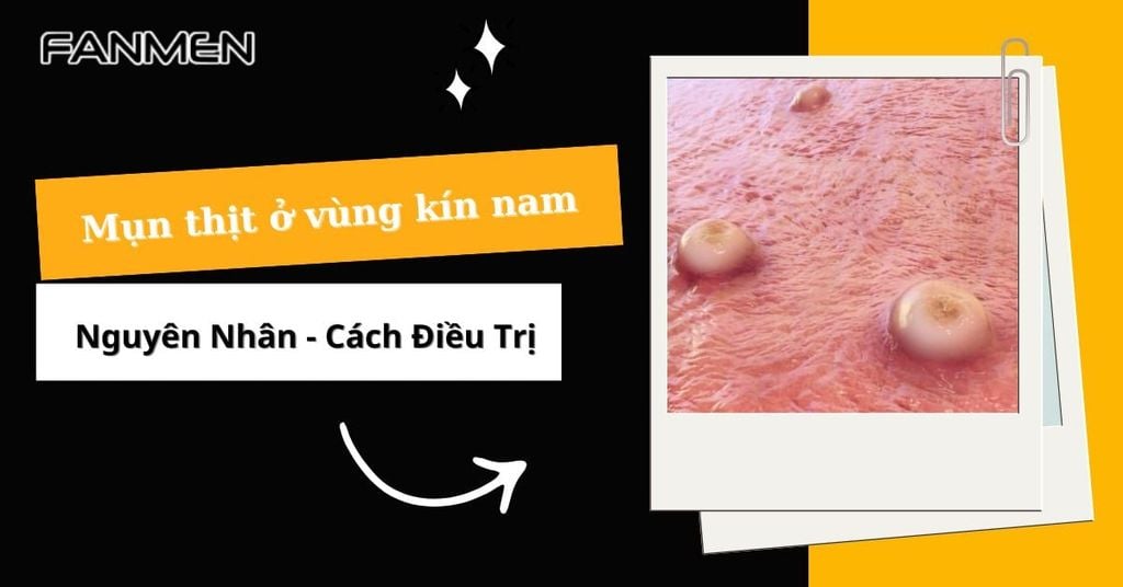 Mụn thịt ở vùng kín nam