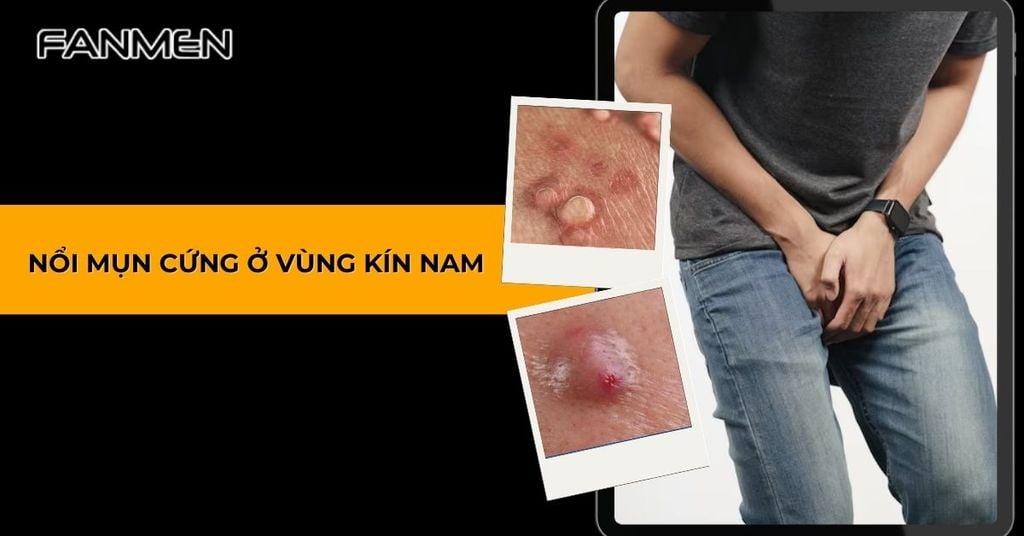nổi mụn cứng ở vùng kín nam