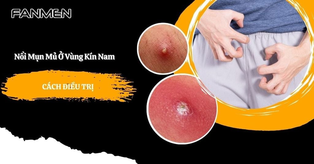 nổi mụn mủ ở vùng kín nam giới