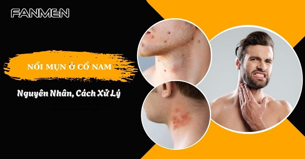 nổi mụn ở cổ nam