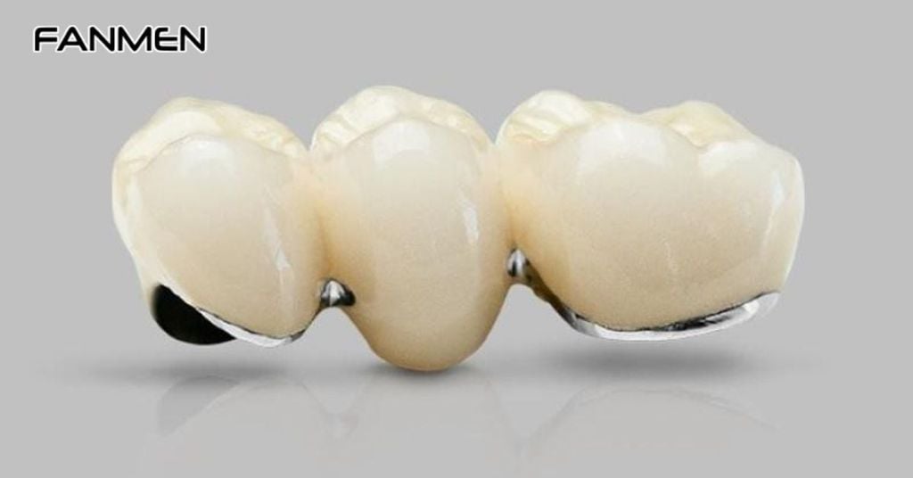 Do oxy hóa kim loại trong răng sứ kim loại