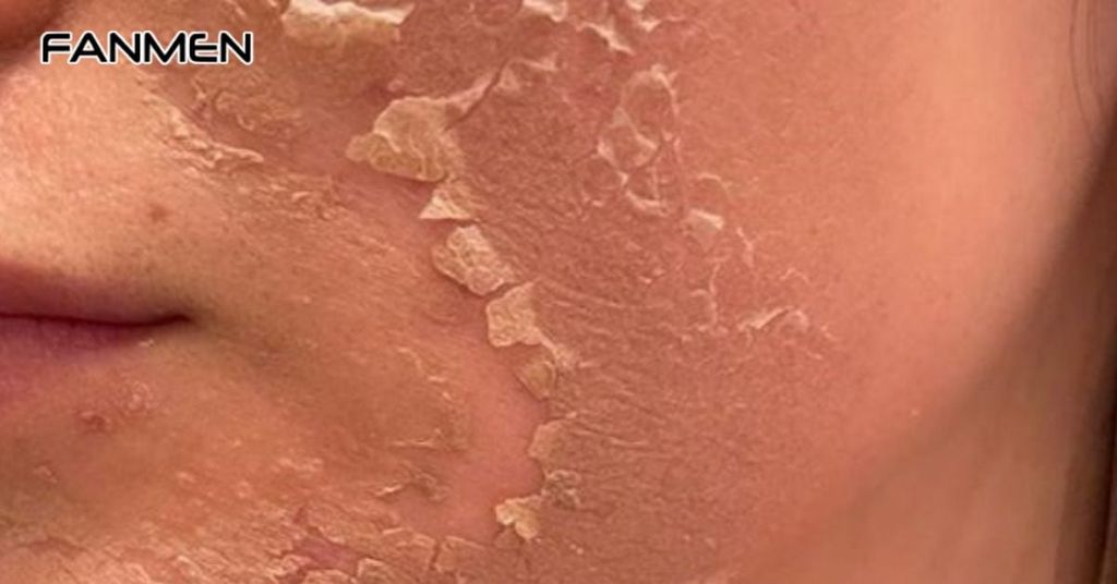 Sử dụng phương pháp peel da