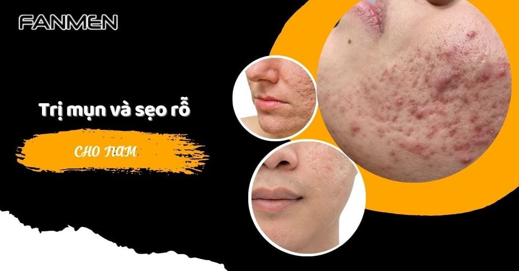 Trị mụn và sẹo rỗ cho nam