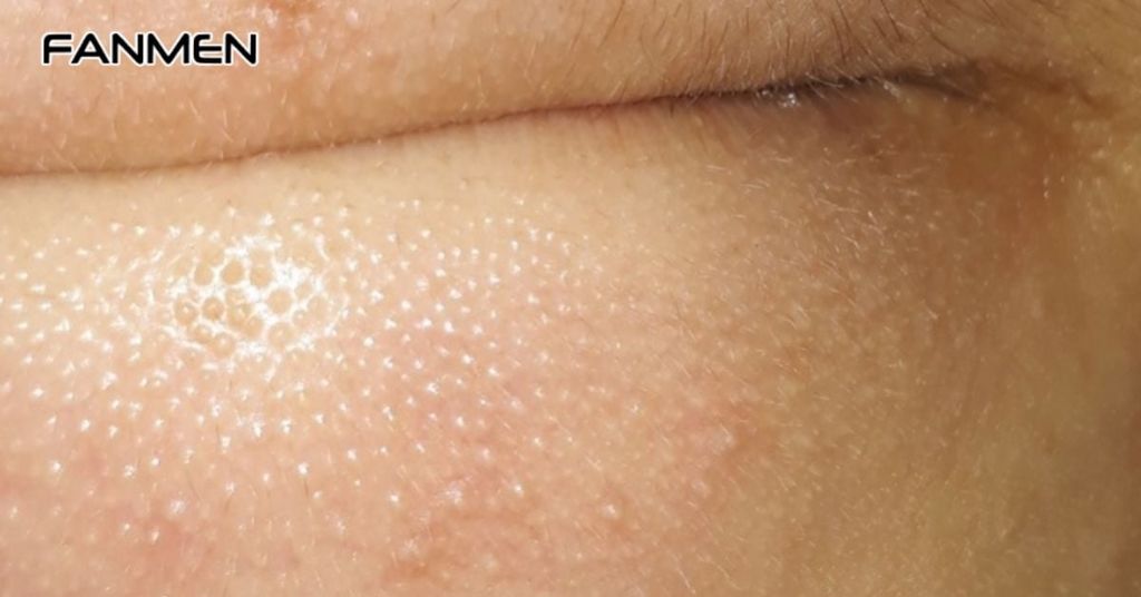Tuyến bã nhờn hoạt động quá mức