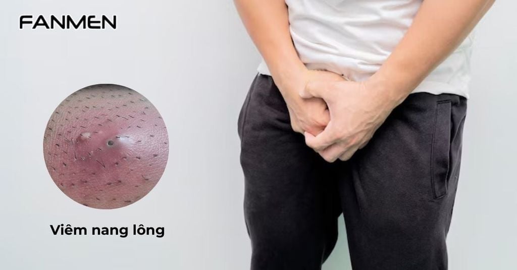 Viêm nang lông