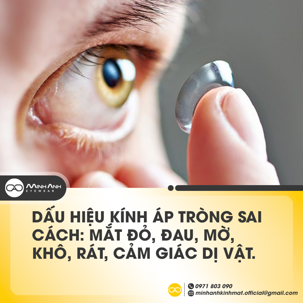 Dấu hiệu kính áp tròng sai cách: mắt đỏ, đau, mờ, khô, rát, cảm giác dị vật. Ngừng dùng và khám bác sĩ ngay nếu gặp phải.