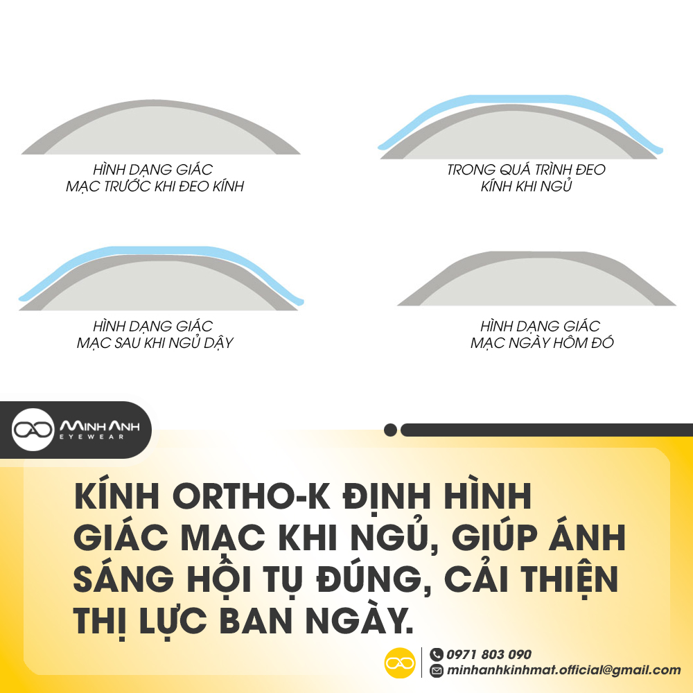 Kính Ortho-K định hình giác mạc khi ngủ, giúp ánh sáng hội tụ đúng, cải thiện thị lực ban ngày.