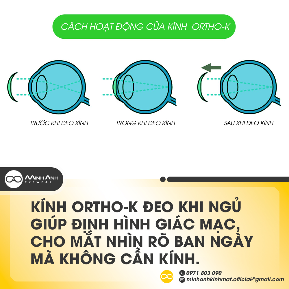 Kính Ortho-K đeo khi ngủ giúp định hình giác mạc, cho mắt nhìn rõ ban ngày mà không cần kính.