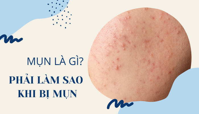 MỤN LÀ GÌ? PHẢI LÀM SAO KHI BỊ MỤN?