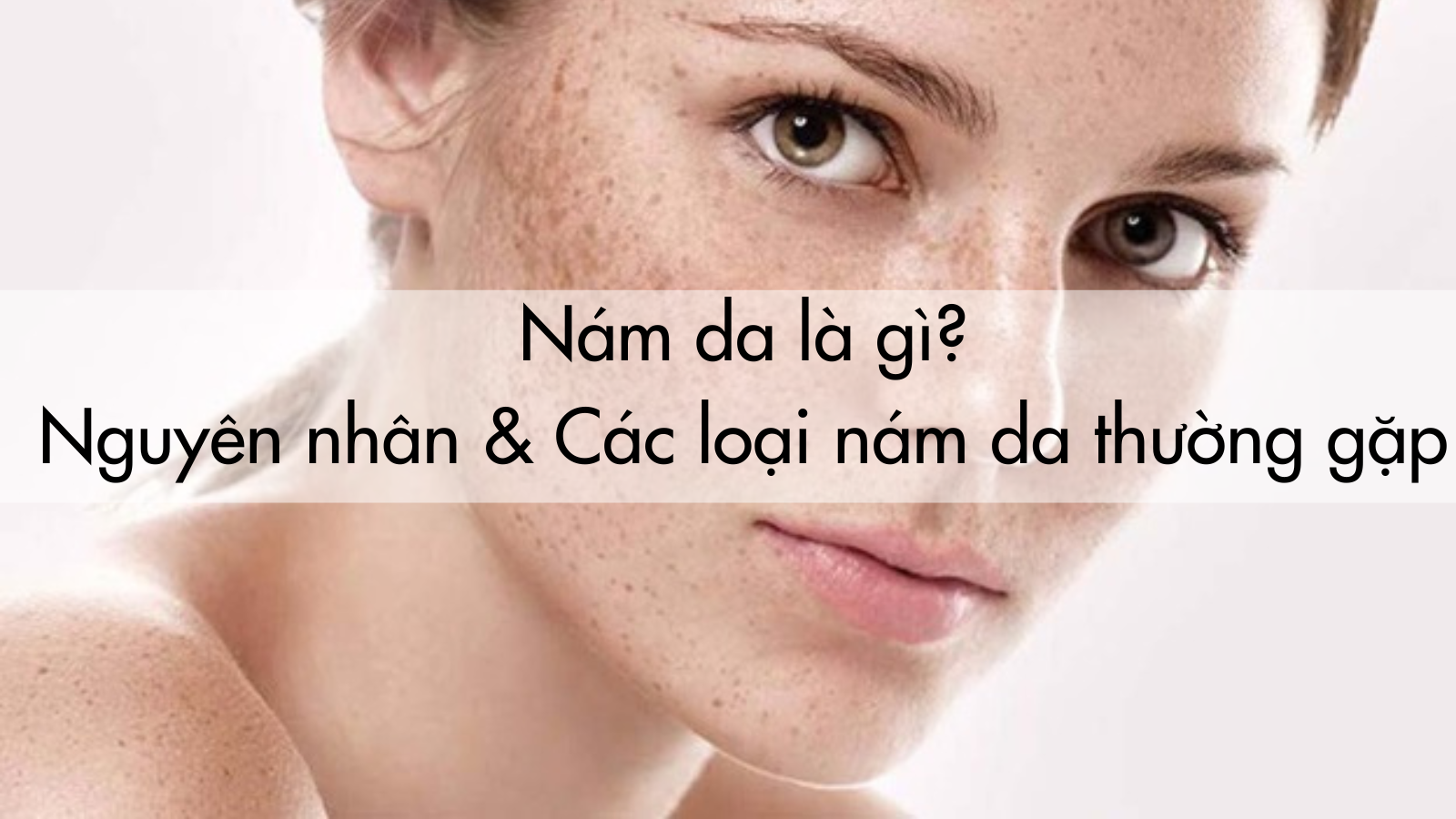 Nám da là gì? Nguyên nhân hình thành và các loại nám da thường gặp