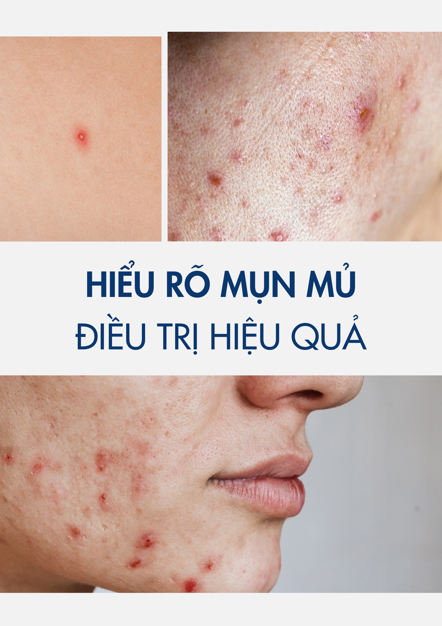 HIỂU RÕ MỤN MỦ VÀ ĐIỀU TRỊ HIỆU QUẢ