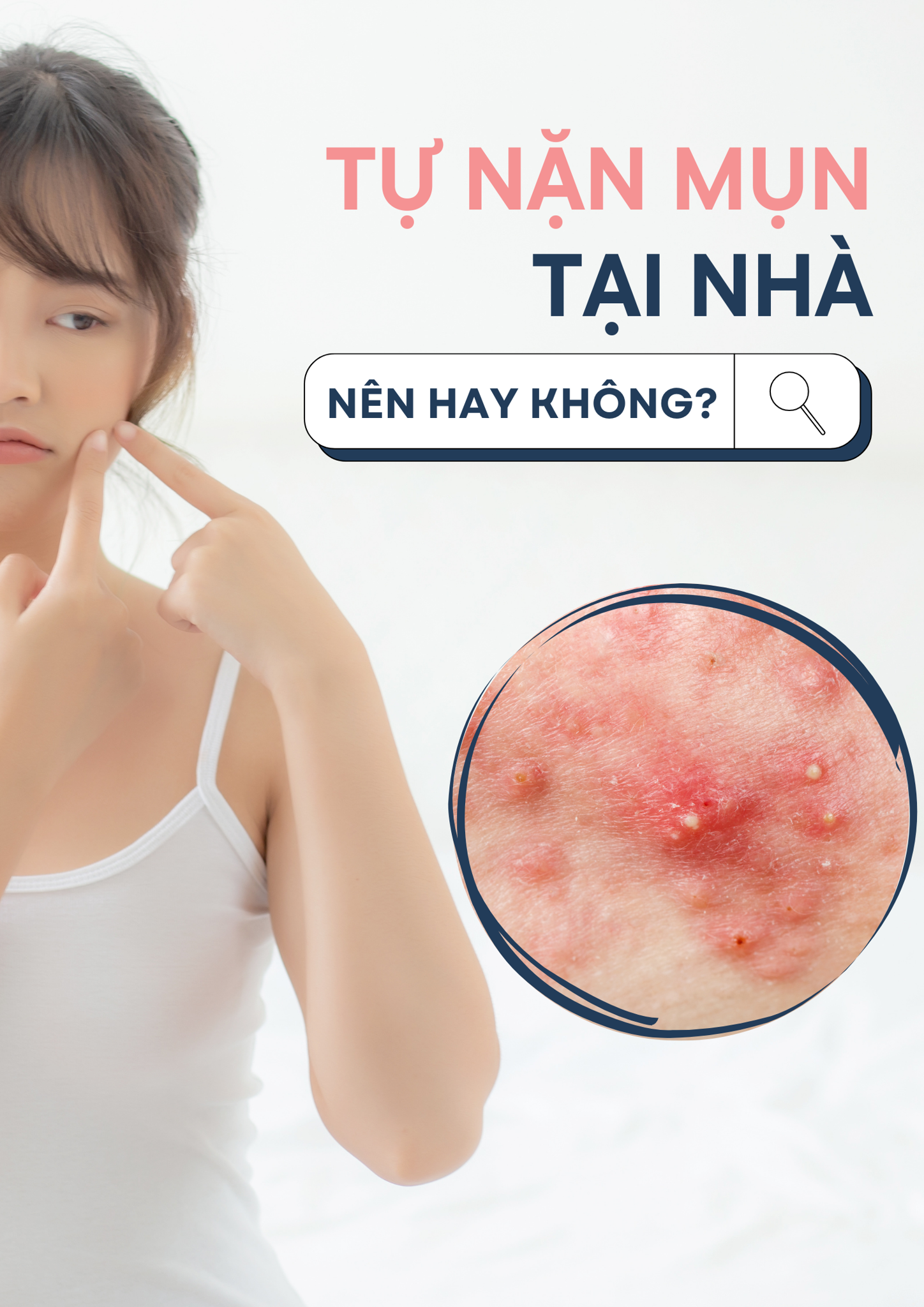 CÓ NÊN NẶN MỤN TẠI NHÀ KHÔNG? LƯU Ý KHI NẶN MỤN TẠI NHÀ