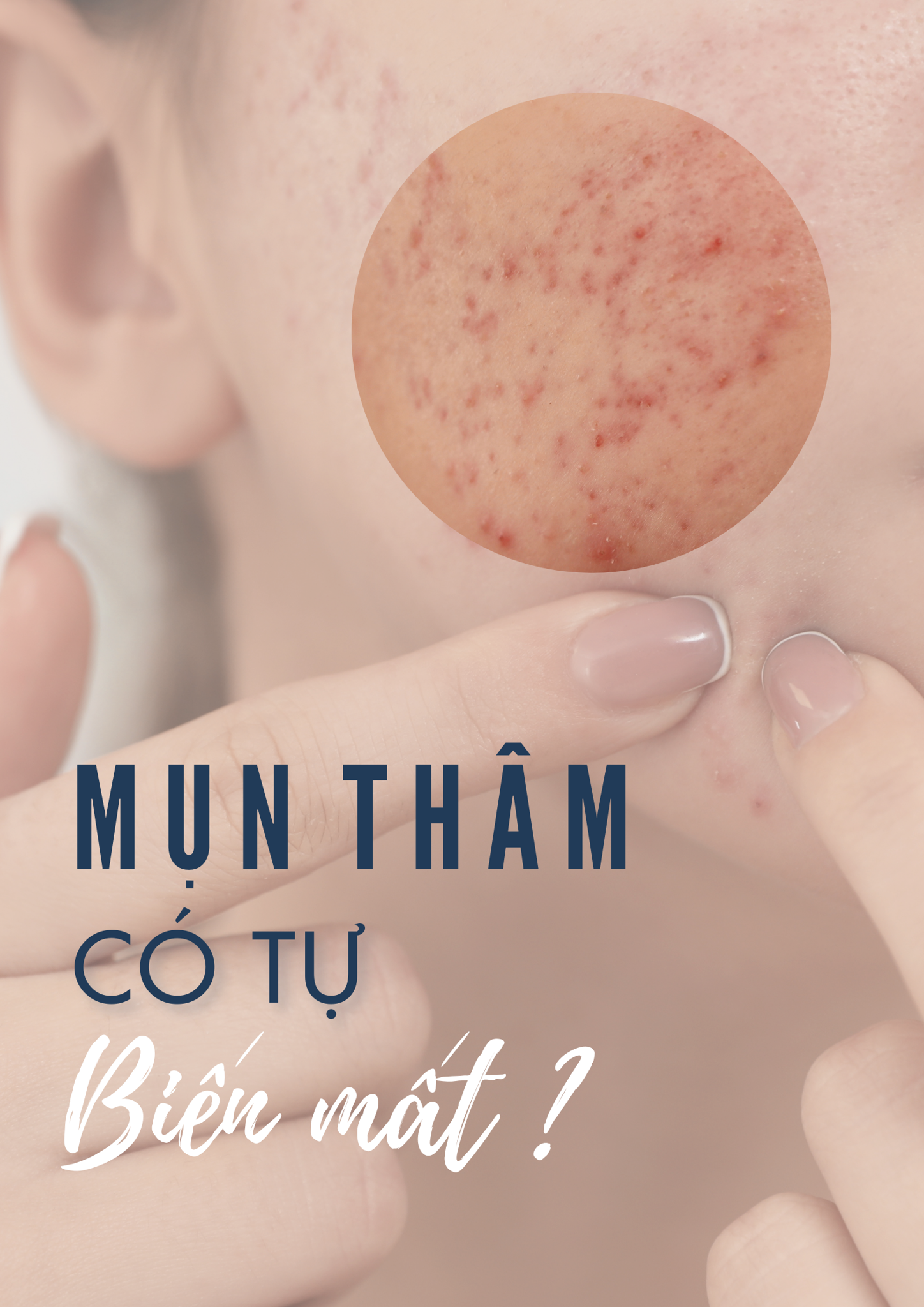 SẸO DO MỤN CÓ TỰ BIẾN MẤT KHÔNG?
