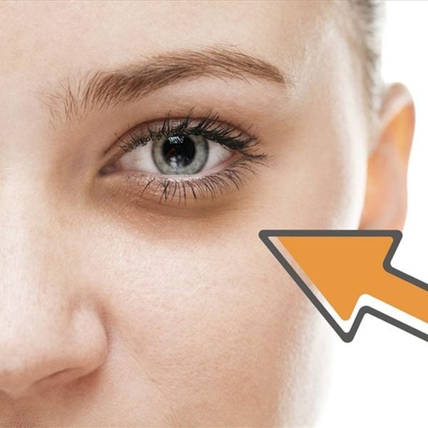 BẠN ĐANG GẶP PHẢI TÌNH TRẠNG THÂM MẮT NÀO?