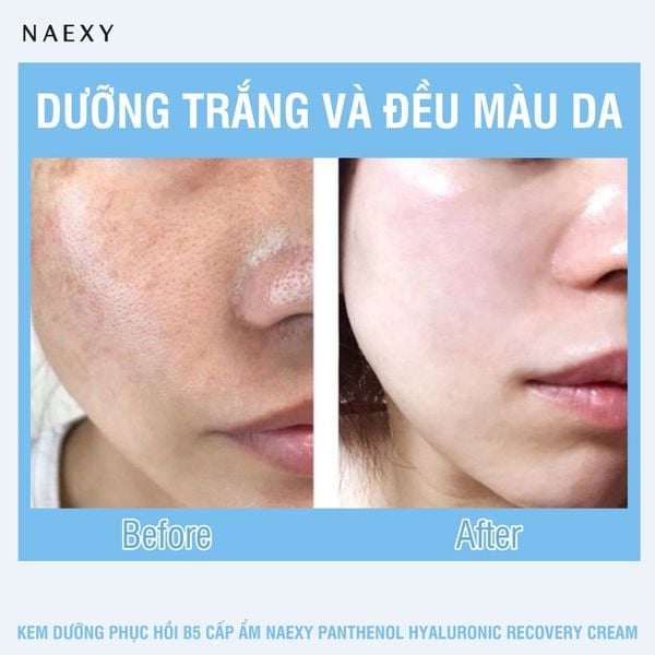 HƯỚNG DẪN SỬ DỤNG KEM DƯỠNG PHỤC HỒI B5 CẤP ẨM NAEXY PANTHENOL HYALURONIC RECOVERY CREAM 50G