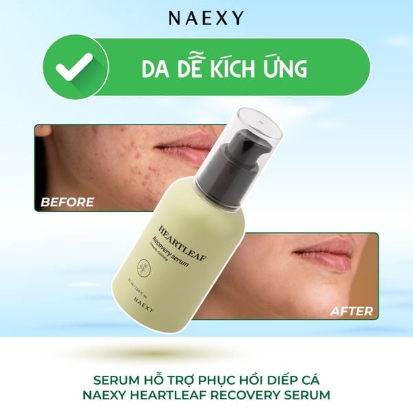Da dễ kích ứng: Serum phục hồi diếp cá Naexy Heartleaf Recovery Serum