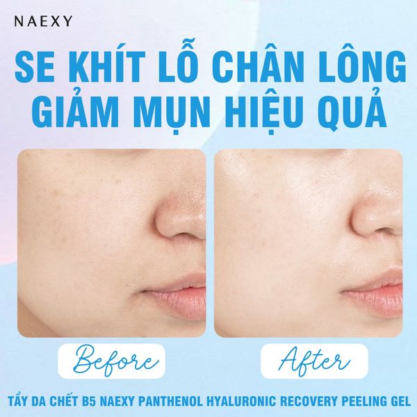 Se khít lỗ chân lông và giảm mụn hiệu quả